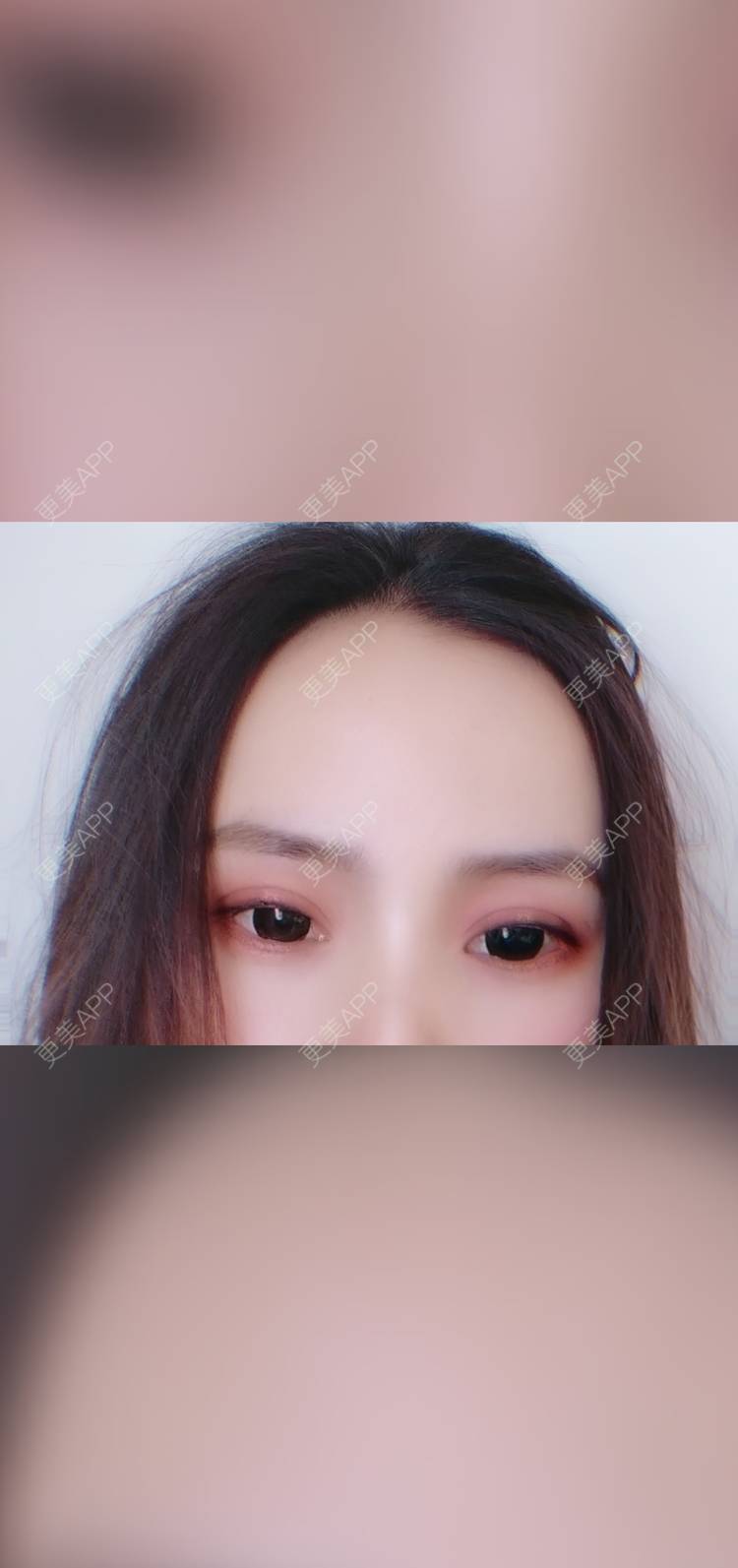 更美 - 更美用户222hTxLwTH的自体脂肪丰卧蚕经验 | 上海 | 自体脂肪丰卧蚕