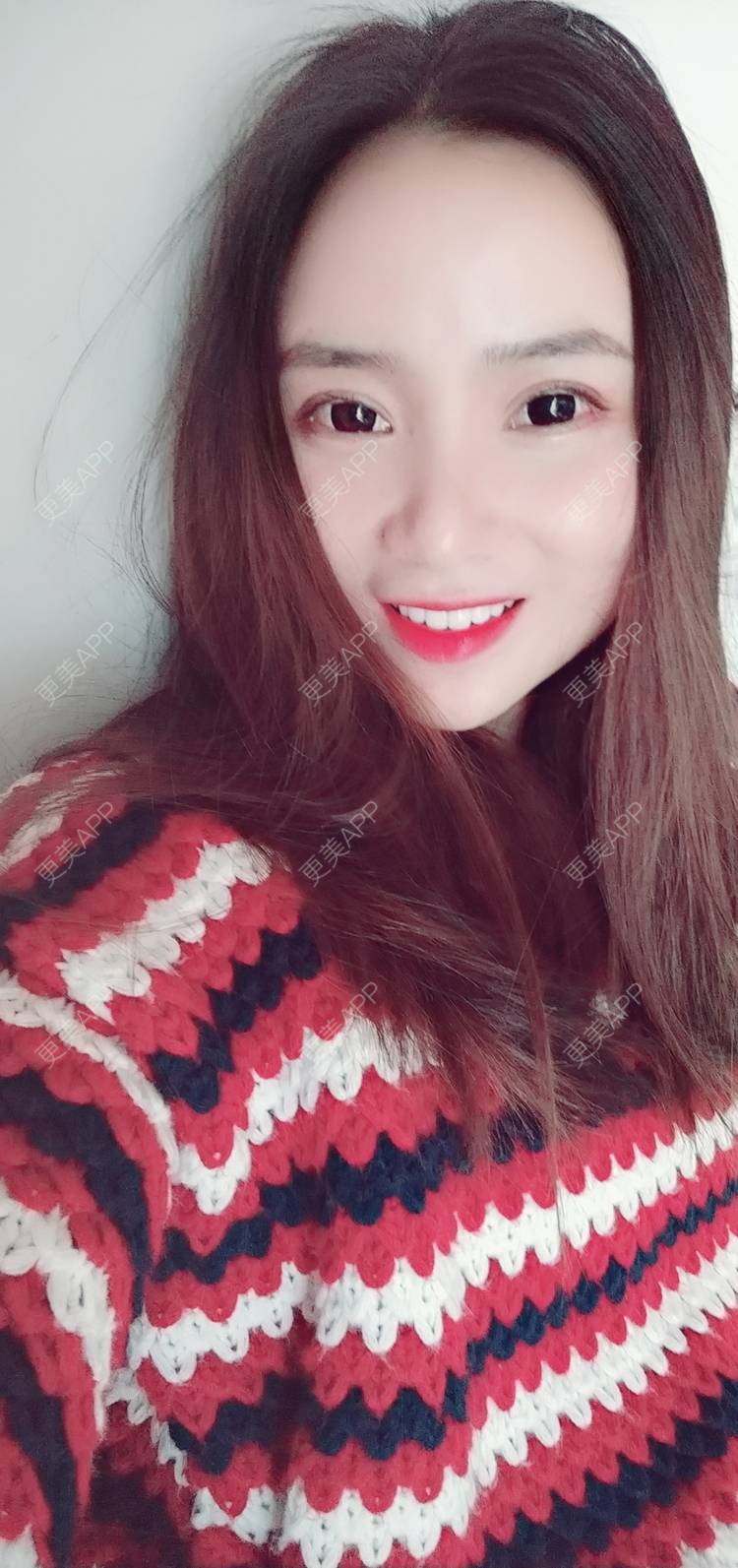 更美 - 更美用户222hTxLwTH的自体脂肪丰卧蚕经验 | 上海 | 自体脂肪丰卧蚕