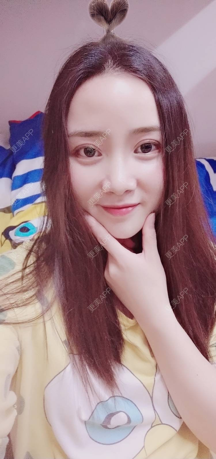 更美 - 更美用户222hTxLwTH的自体脂肪丰卧蚕经验 | 上海 | 自体脂肪丰卧蚕