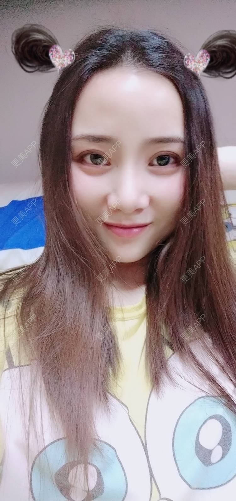 更美 - 更美用户222hTxLwTH的自体脂肪丰卧蚕经验 | 上海 | 自体脂肪丰卧蚕