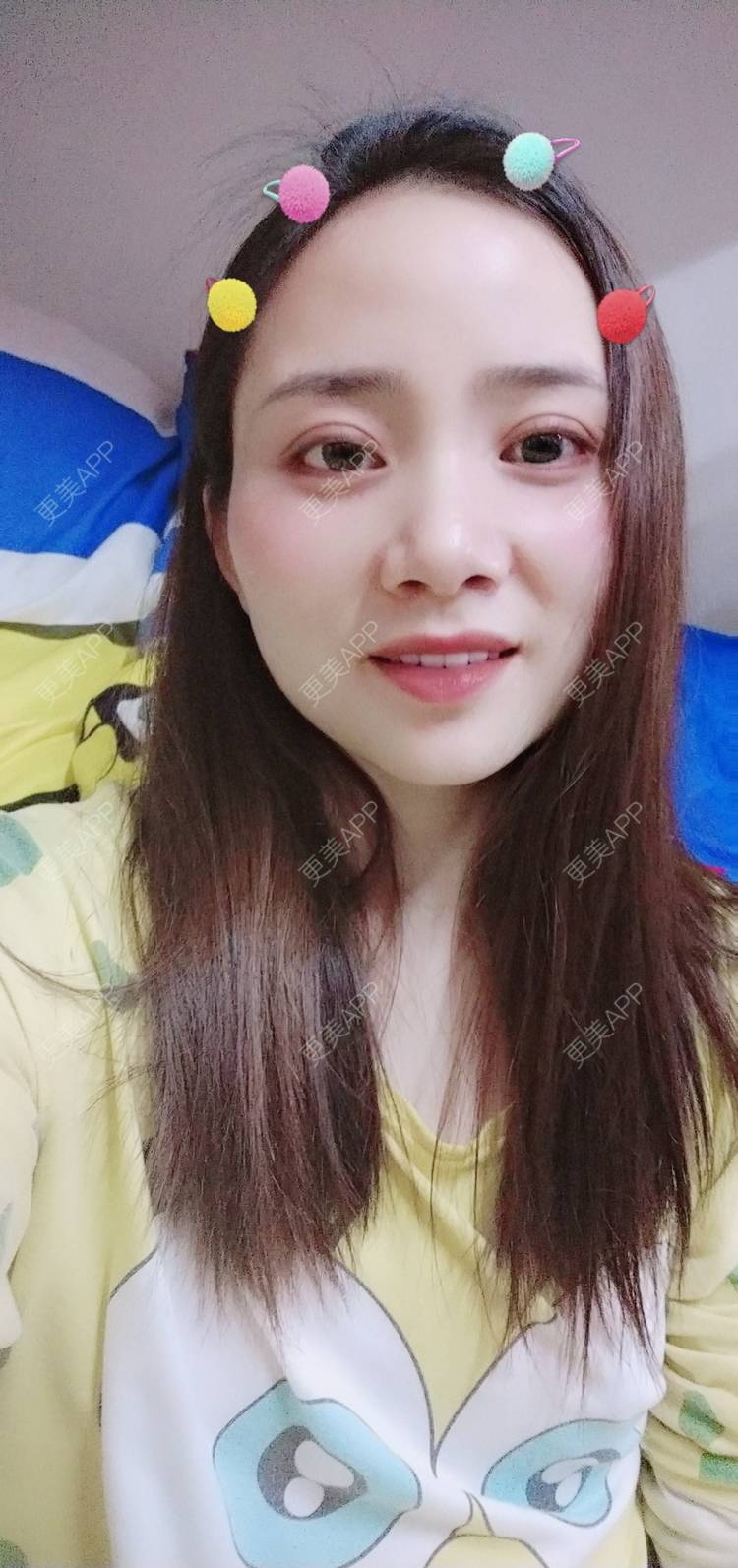 更美 - 更美用户222hTxLwTH的自体脂肪丰卧蚕经验 | 上海 | 自体脂肪丰卧蚕
