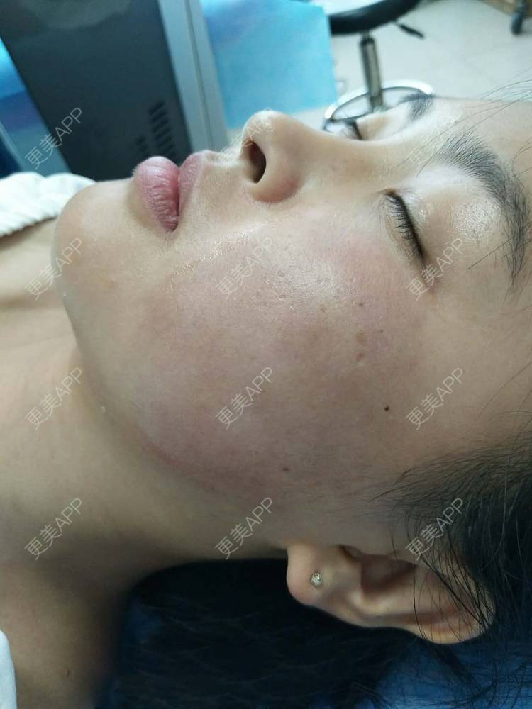 更美 - 更美用户zbTIjUxlUN的激光淡化红血丝经验 | 激光淡化红血丝 | 广州