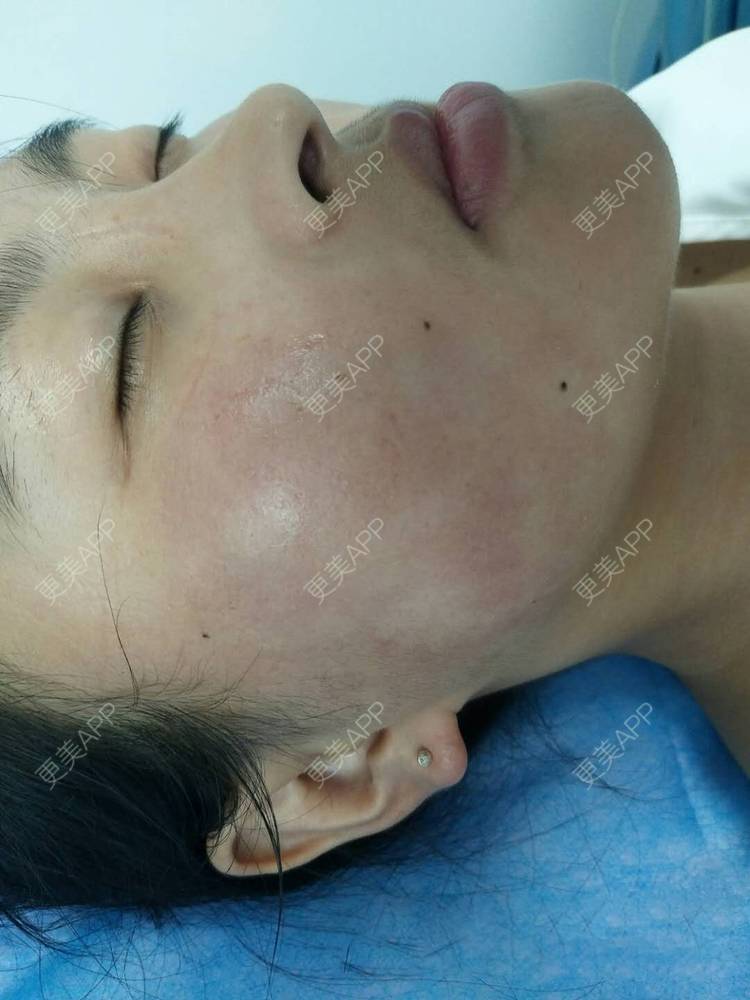 更美 - 更美用户zbTIjUxlUN的激光淡化红血丝经验 | 激光淡化红血丝 | 广州