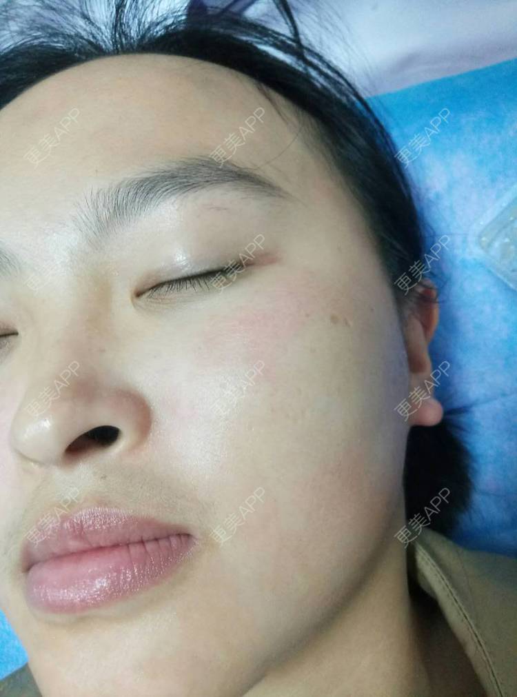 更美 - 更美用户zbTIjUxlUN的激光淡化红血丝经验 | 激光淡化红血丝 | 广州