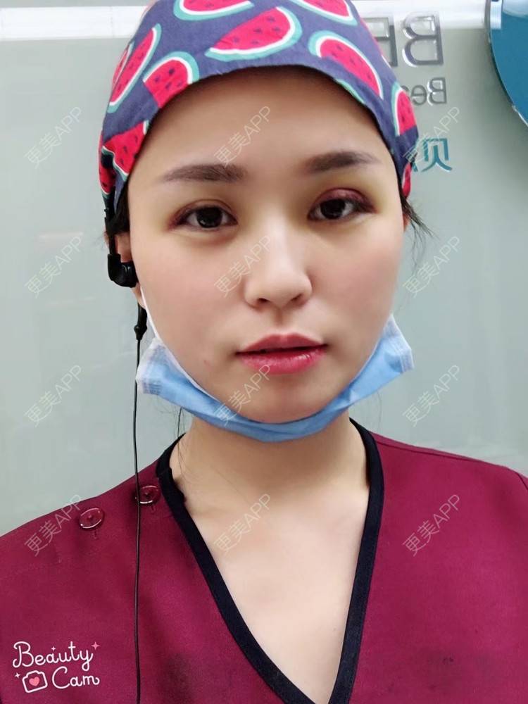 更美 - 更美用户aPZ5J5UfoG的全切双眼皮经验 | 全切双眼皮 | 深圳