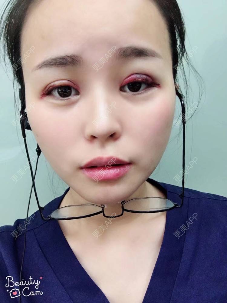 更美 - 更美用户aPZ5J5UfoG的全切双眼皮经验 | 全切双眼皮 | 深圳