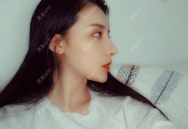 如故梦的肋软骨隆鼻日记