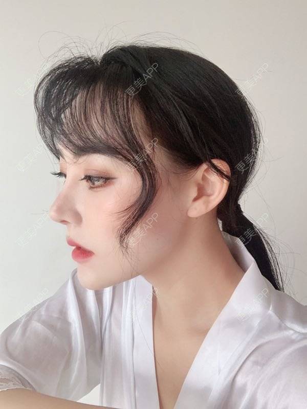 隆鼻,隆鼻效果图_更美用户s7x6jvoy2m隆鼻效果图_术后57天__更美