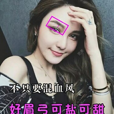自体脂肪垫眉弓