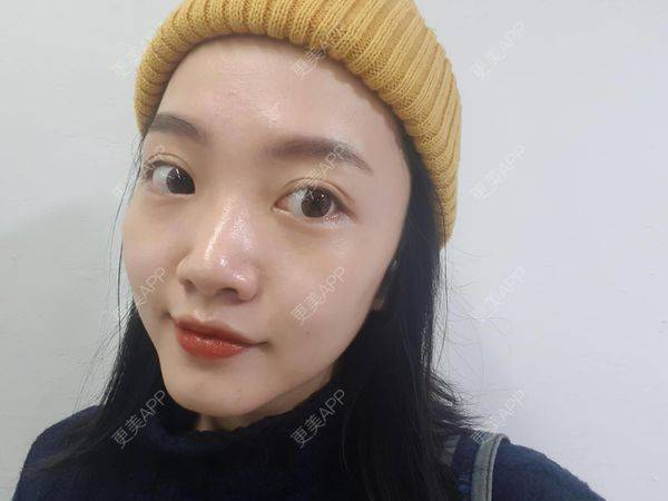 更美 - 💋夕夕💕的镭射净肤经验 | 深圳 | 镭射净肤