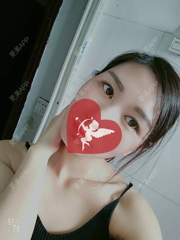 更美 - 杨丽 医生的双眼皮经验 | 双眼皮