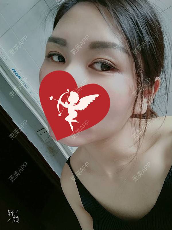 更美 - 杨丽 医生的双眼皮经验 | 双眼皮