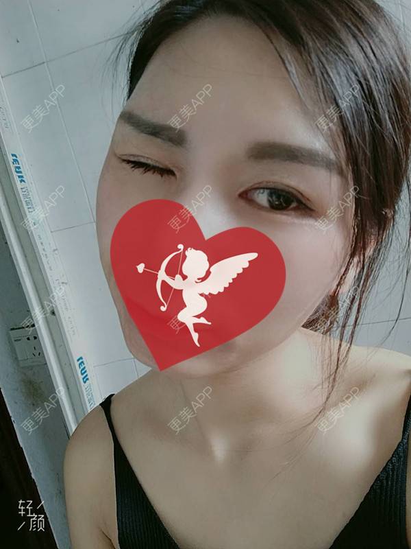 更美 - 杨丽 医生的双眼皮经验 | 双眼皮