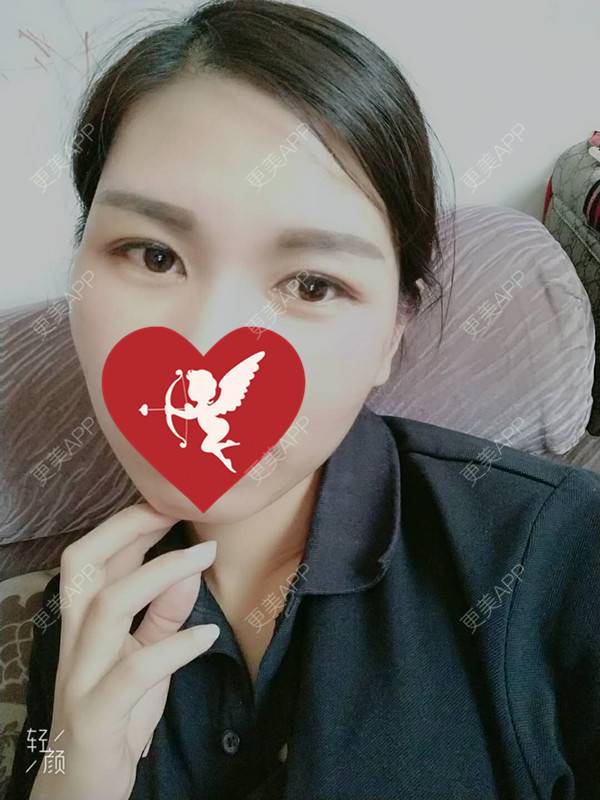 更美 - 杨丽 医生的双眼皮经验 | 双眼皮