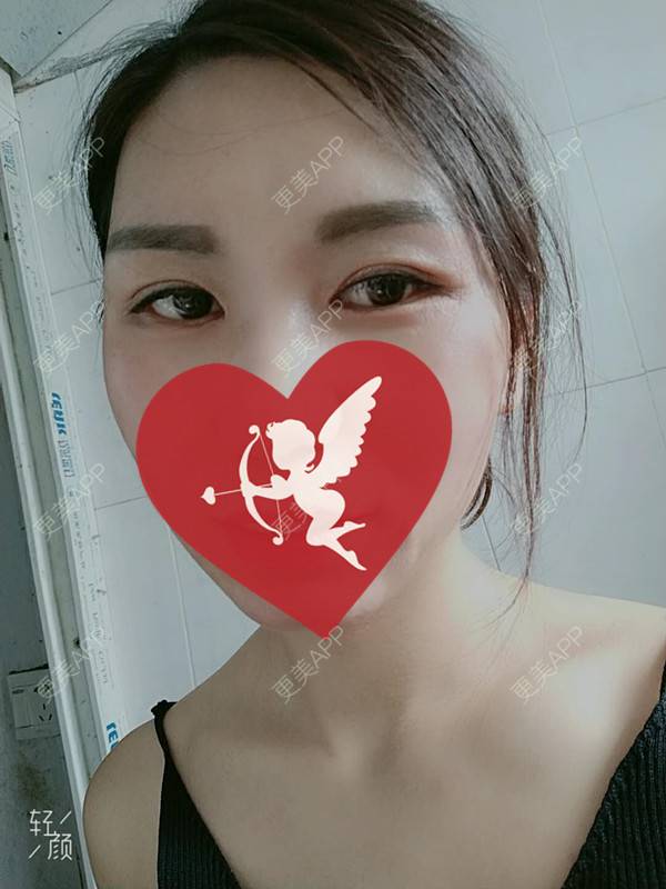 更美 - 杨丽 医生的双眼皮经验 | 双眼皮