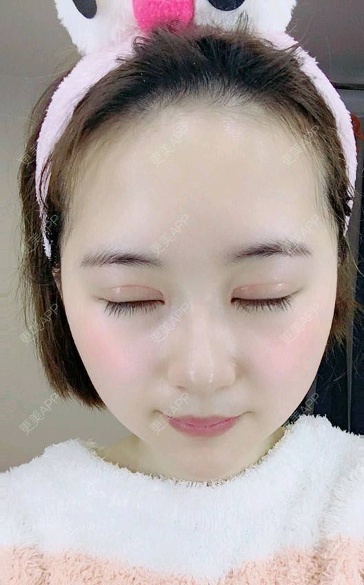 更美 - 更美用户UKpYYuDcZJ的双眼皮经验 | 双眼皮 | 佛山