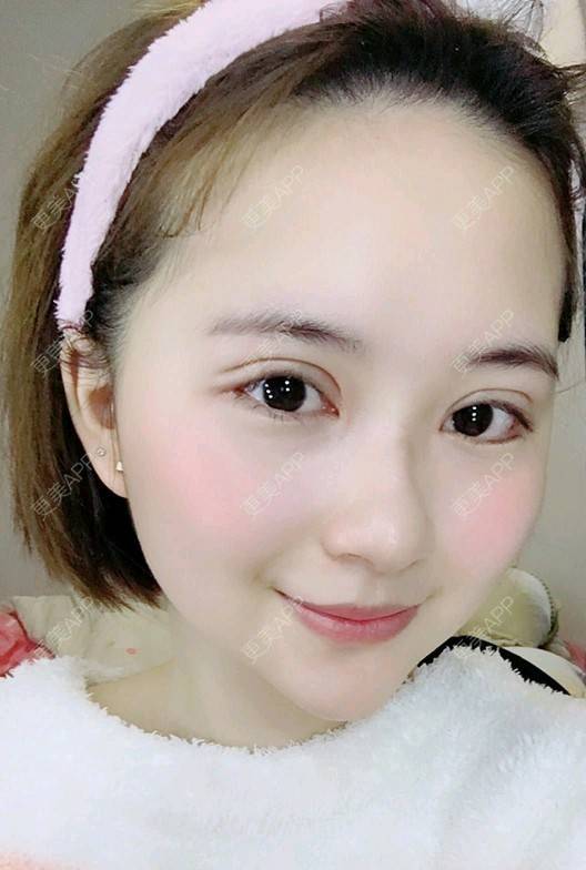 更美 - 更美用户UKpYYuDcZJ的双眼皮经验 | 双眼皮 | 佛山