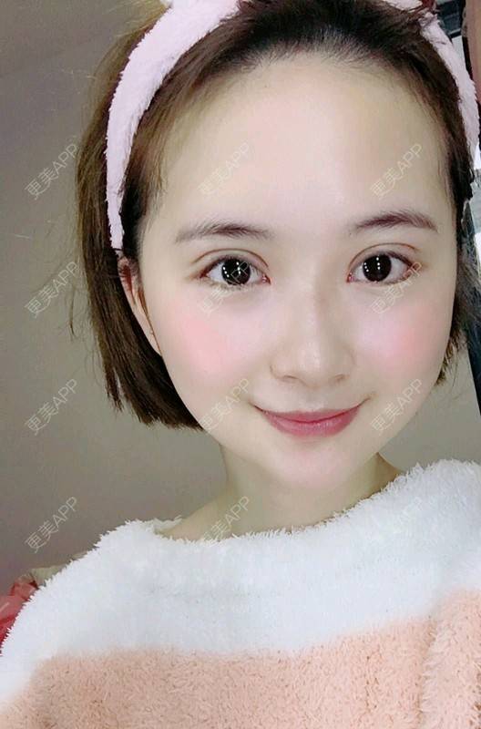 更美 - 更美用户UKpYYuDcZJ的双眼皮经验 | 双眼皮 | 佛山