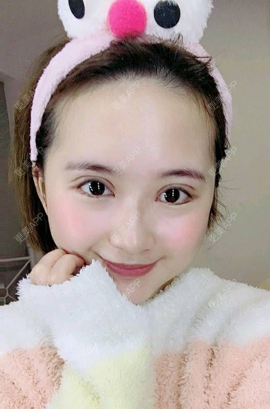 更美 - 更美用户UKpYYuDcZJ的双眼皮经验 | 双眼皮 | 佛山