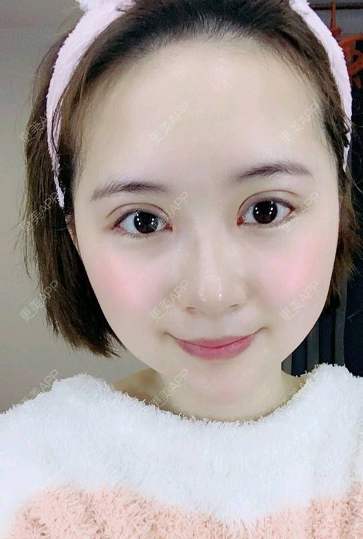 更美 - 更美用户UKpYYuDcZJ的双眼皮经验 | 双眼皮 | 佛山