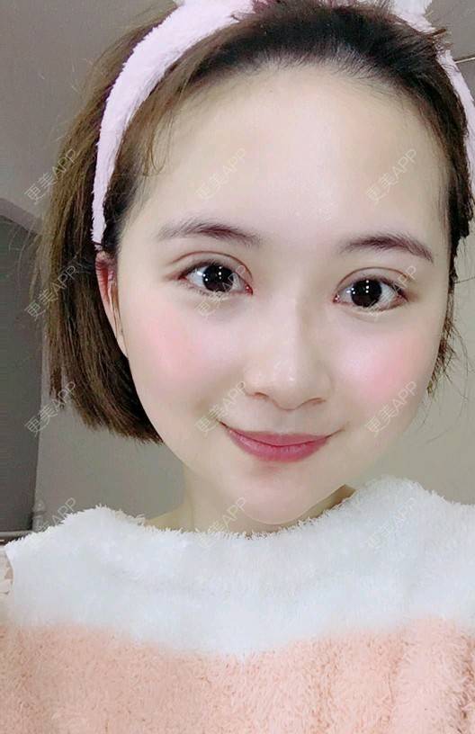 更美 - 更美用户UKpYYuDcZJ的双眼皮经验 | 双眼皮 | 佛山