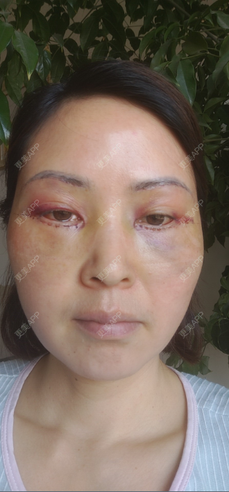 更美用户zdzuytccg6的内切去眼袋日记