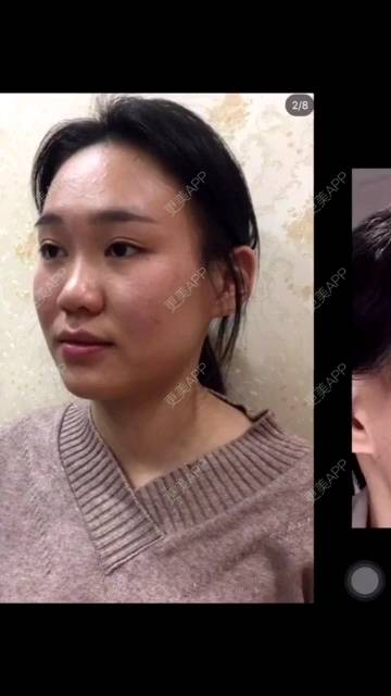 更美 - 兔子  520的全切双眼皮经验 | 全切双眼皮 | 埋线双眼皮 | 上海 | 胶原蛋白淡化黑眼圈 | 自体脂肪丰卧蚕 | 眼部多项