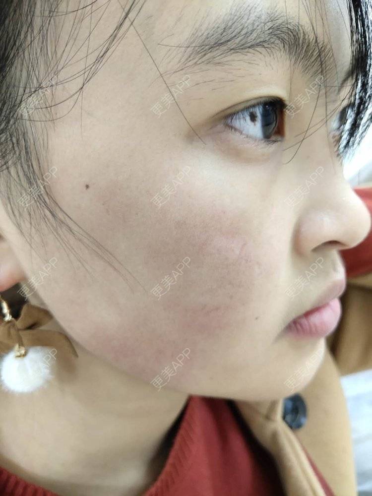 更美 - 更美用户zbTIjUxlUN的激光淡化红血丝经验 | 广州 | 激光淡化红血丝