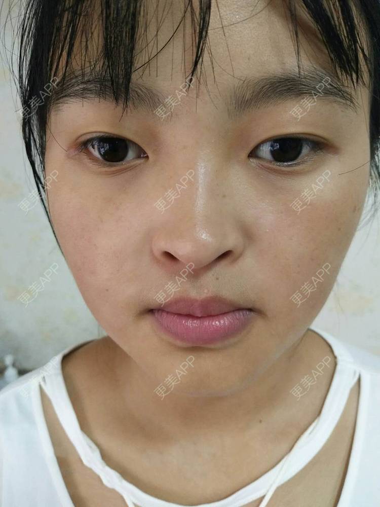 更美 - 更美用户zbTIjUxlUN的激光淡化红血丝经验 | 广州 | 激光淡化红血丝