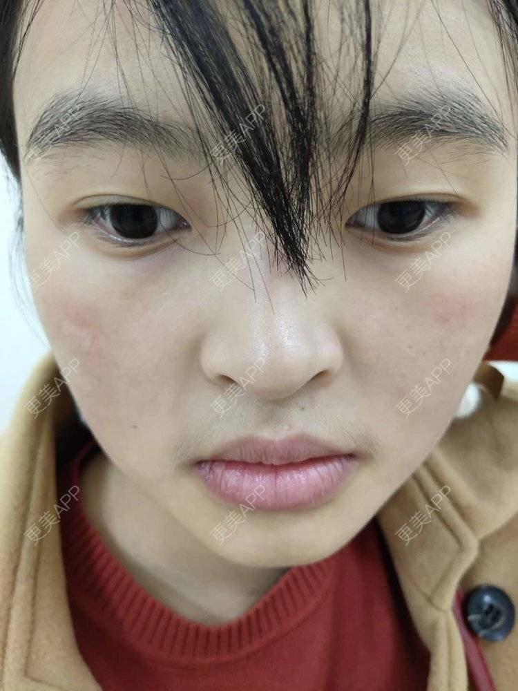 更美 - 更美用户zbTIjUxlUN的激光淡化红血丝经验 | 广州 | 激光淡化红血丝