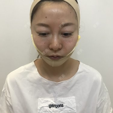 米果儿er的下颌角切除术日记