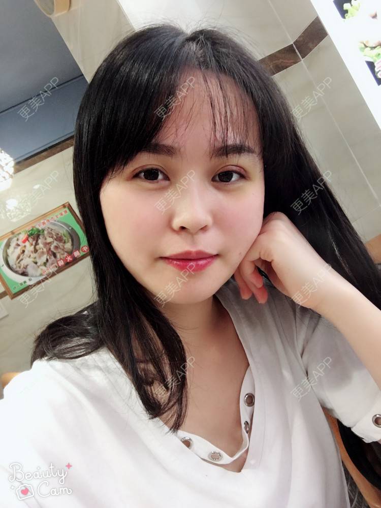 更美 - 更美用户aPZ5J5UfoG的全切双眼皮经验 | 全切双眼皮 | 深圳