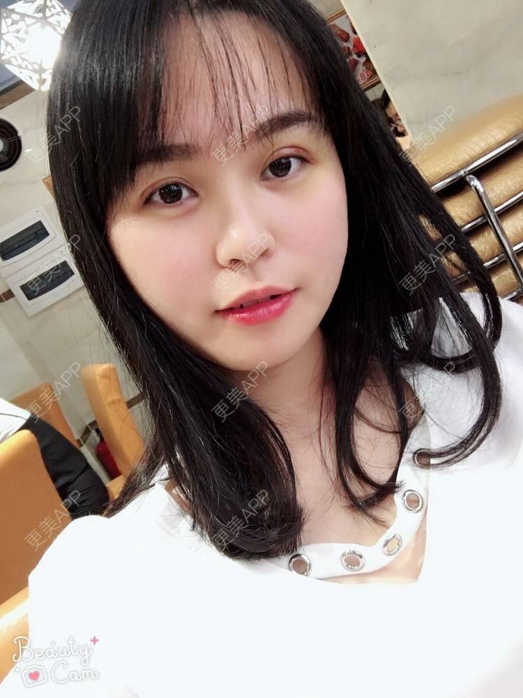 更美 - 更美用户aPZ5J5UfoG的全切双眼皮经验 | 全切双眼皮 | 深圳