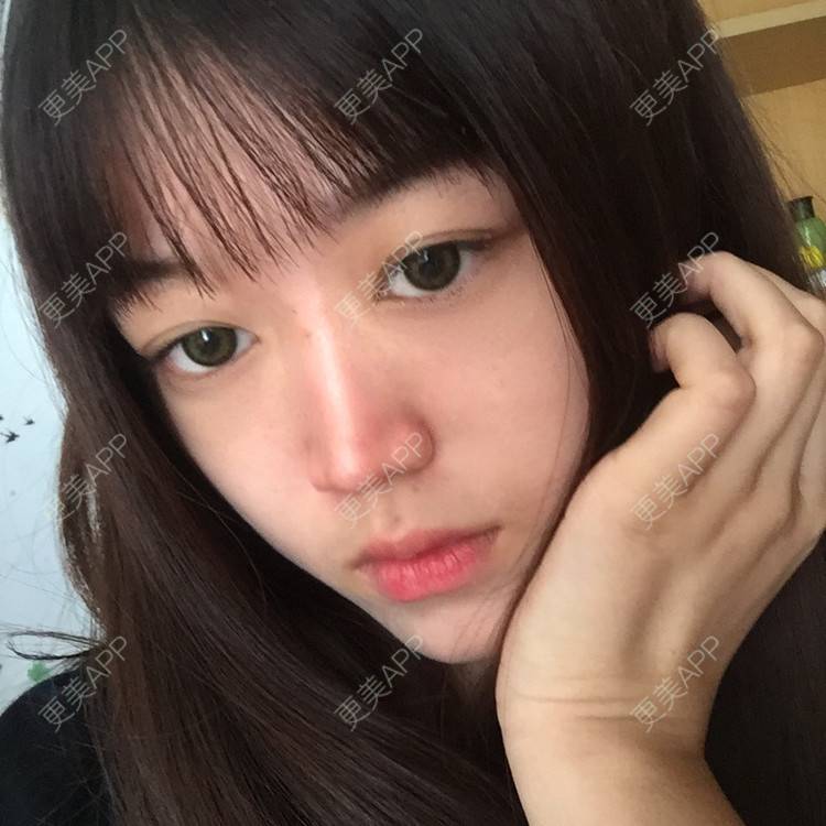 更美 - 妞妞牛小米的鼻部多项经验 | 鼻部多项 | 全脸整形套餐 | 鼻小柱缩短 | 手术缩鼻头 | 自体软骨垫鼻尖 | 上海 | 鼻中隔软骨垫鼻头