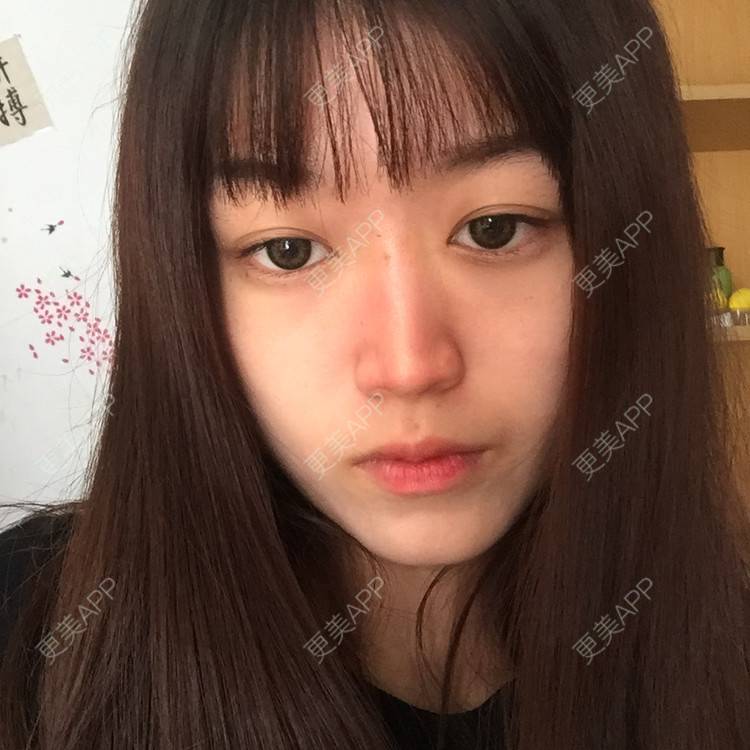 更美 - 妞妞牛小米的鼻部多项经验 | 鼻部多项 | 全脸整形套餐 | 鼻小柱缩短 | 手术缩鼻头 | 自体软骨垫鼻尖 | 上海 | 鼻中隔软骨垫鼻头