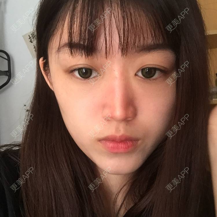 更美 - 妞妞牛小米的鼻部多项经验 | 鼻部多项 | 全脸整形套餐 | 鼻小柱缩短 | 手术缩鼻头 | 自体软骨垫鼻尖 | 上海 | 鼻中隔软骨垫鼻头