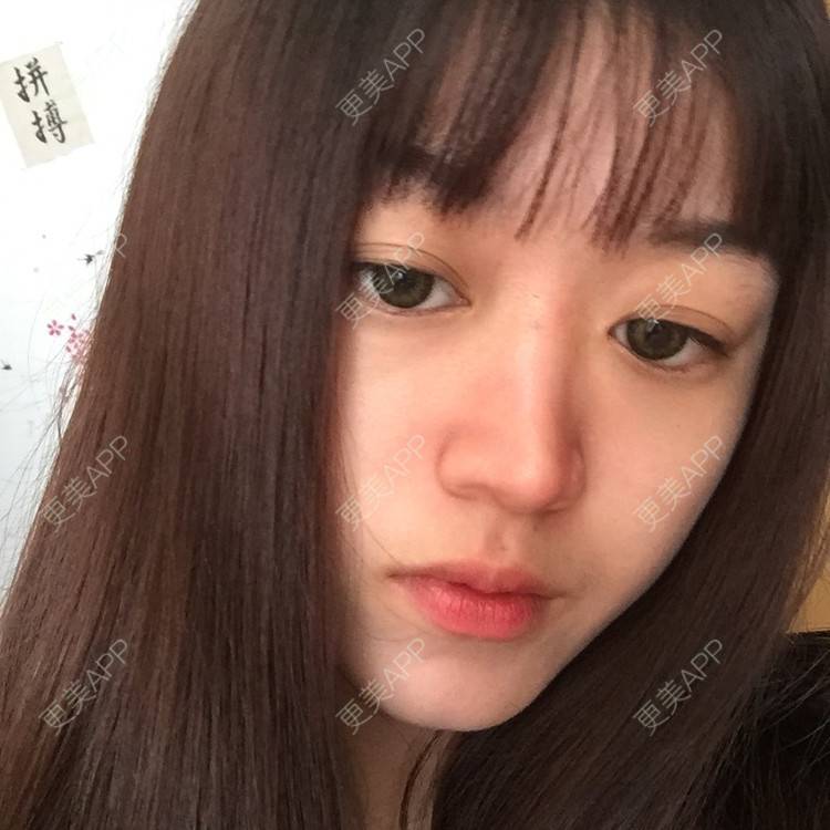 更美 - 妞妞牛小米的鼻部多项经验 | 鼻部多项 | 全脸整形套餐 | 鼻小柱缩短 | 手术缩鼻头 | 自体软骨垫鼻尖 | 上海 | 鼻中隔软骨垫鼻头