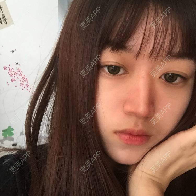 更美 - 妞妞牛小米的鼻部多项经验 | 鼻部多项 | 全脸整形套餐 | 鼻小柱缩短 | 手术缩鼻头 | 自体软骨垫鼻尖 | 上海 | 鼻中隔软骨垫鼻头
