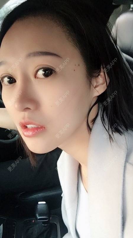 更美 - 小小苗子的隆鼻经验 | 鼻部综合 | 鼻部膨体假体取出 | 隆鼻 | 广州