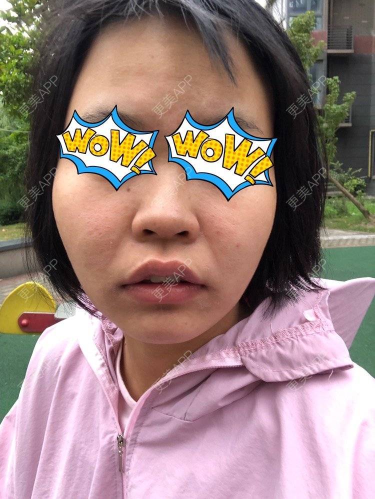 更美 - 天空好像下雨☔️的玻尿酸面部细纹经验 | 玻尿酸面部细纹 | 上海