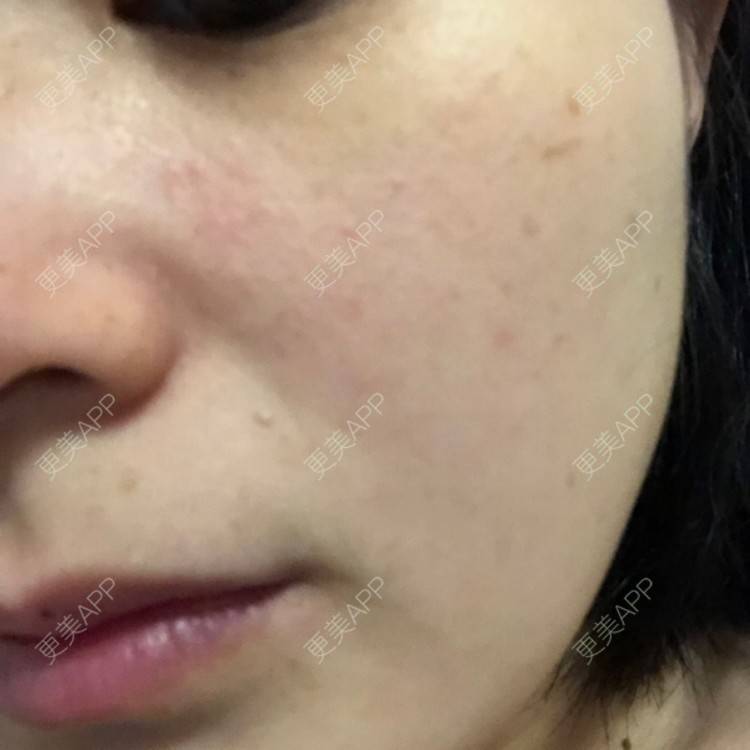 更美 - 一白遮三丑丑丑的舒敏之星经验 | 上海 | 舒敏之星