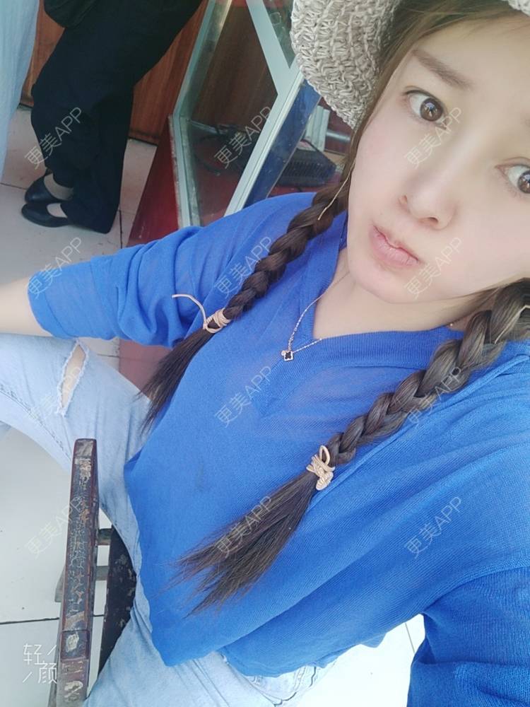 更美 - A孟先生的内切去眼袋经验 | 内切去眼袋 | 苏州