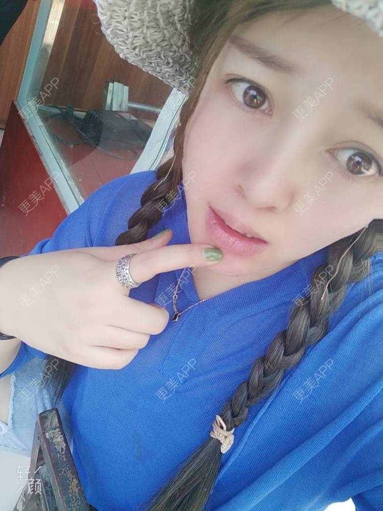 更美 - A孟先生的内切去眼袋经验 | 内切去眼袋 | 苏州