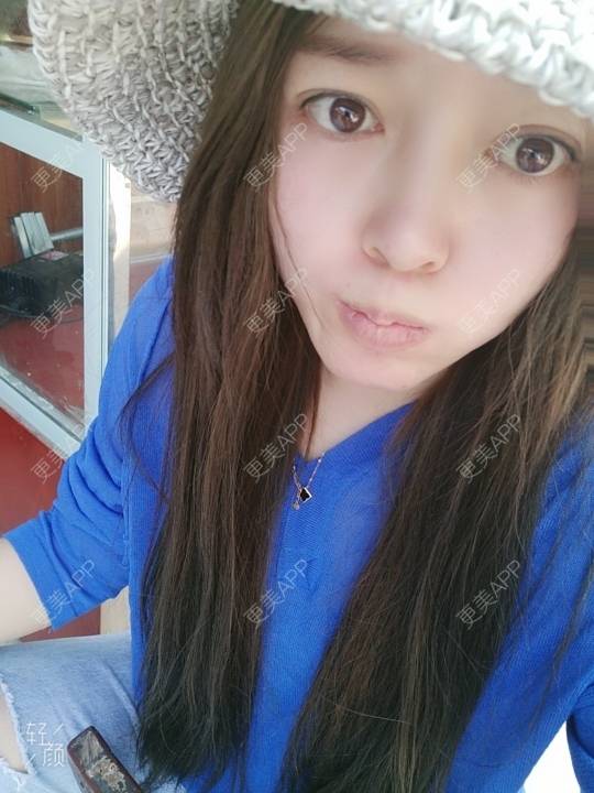 更美 - A孟先生的内切去眼袋经验 | 内切去眼袋 | 苏州