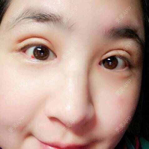 更美用户np2wms0dlm的全切双眼皮日记