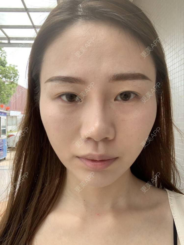 更美 - ahah的牙齿矫正经验 | 牙齿矫正 | 广州