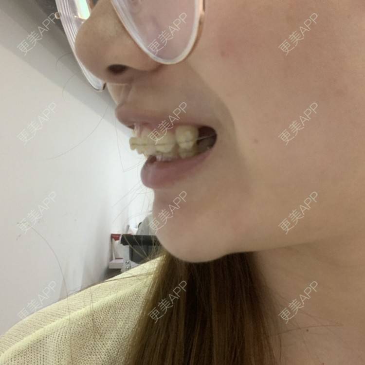 更美 - ahah的牙齿矫正经验 | 牙齿矫正 | 广州