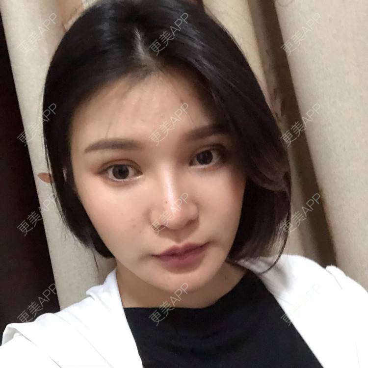 更美 - 更美用户0GOaTxhYaU的鼻部多项经验 | 温州 | 鼻部多项