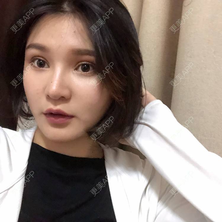 更美 - 更美用户0GOaTxhYaU的鼻部多项经验 | 温州 | 鼻部多项