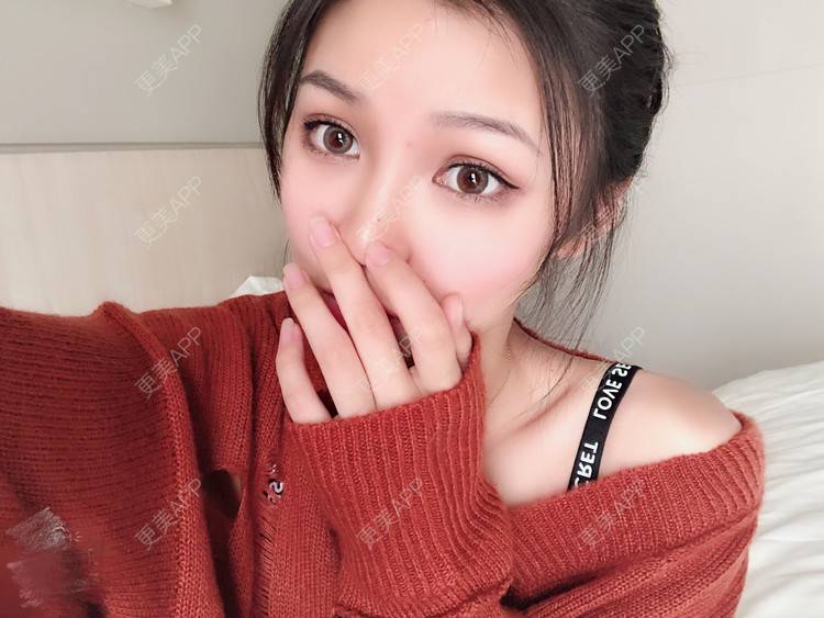 更美 - 更美用户0GOaTxhYaU的鼻部多项经验 | 温州 | 鼻部多项